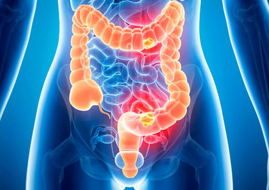 Qué es el cáncer de colon y cuáles son sus síntomas